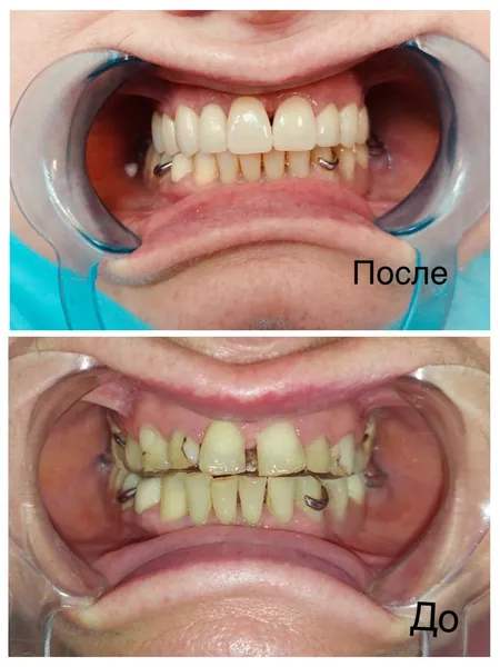 Ортопедическая коррекция верхней челюсти