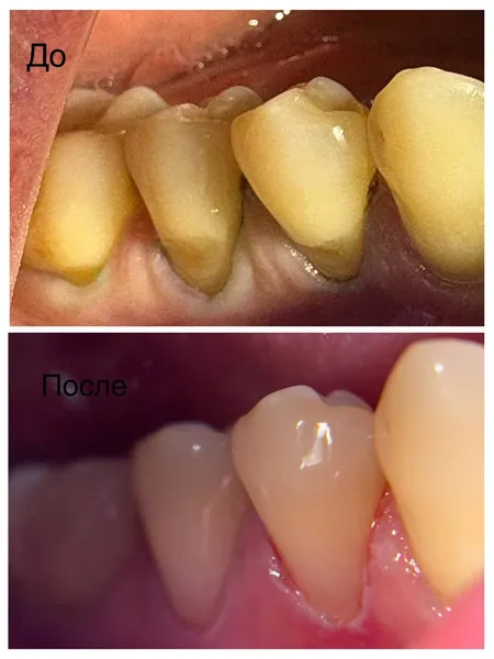 Клиновидные дефекты